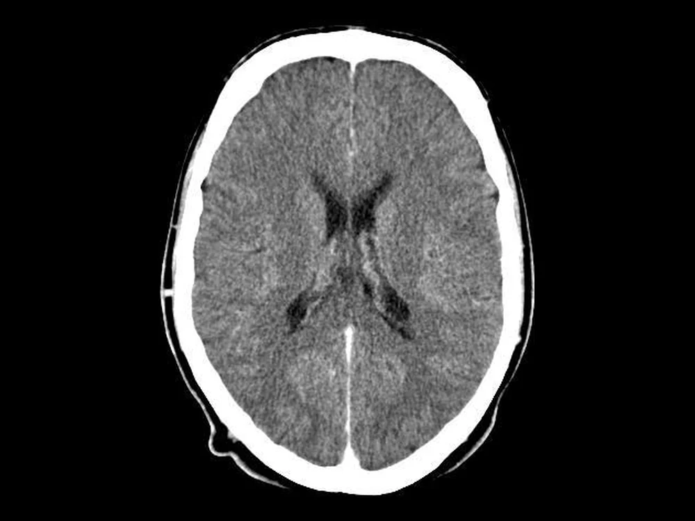 Secțiune axială de tomografie computerizată craniană, la nivelul ventriculilor laterali